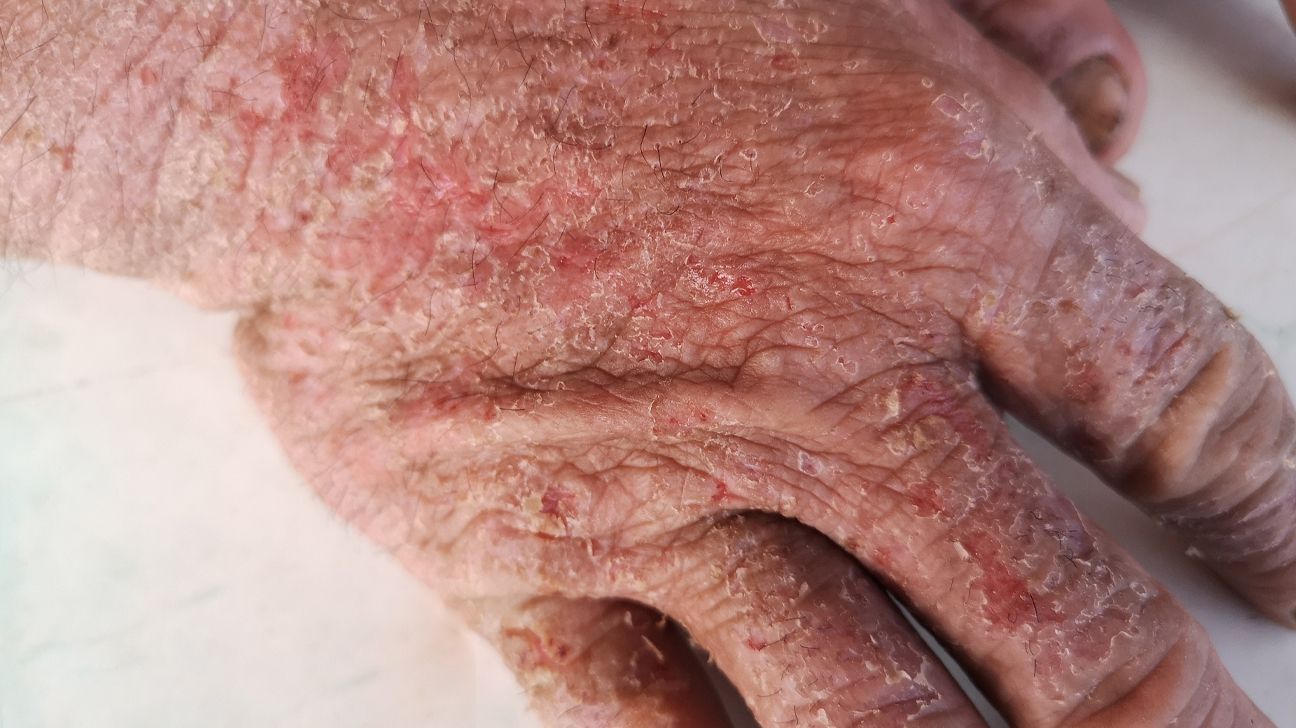 What Can Cause Contact Dermatitis?, image size:1296x728