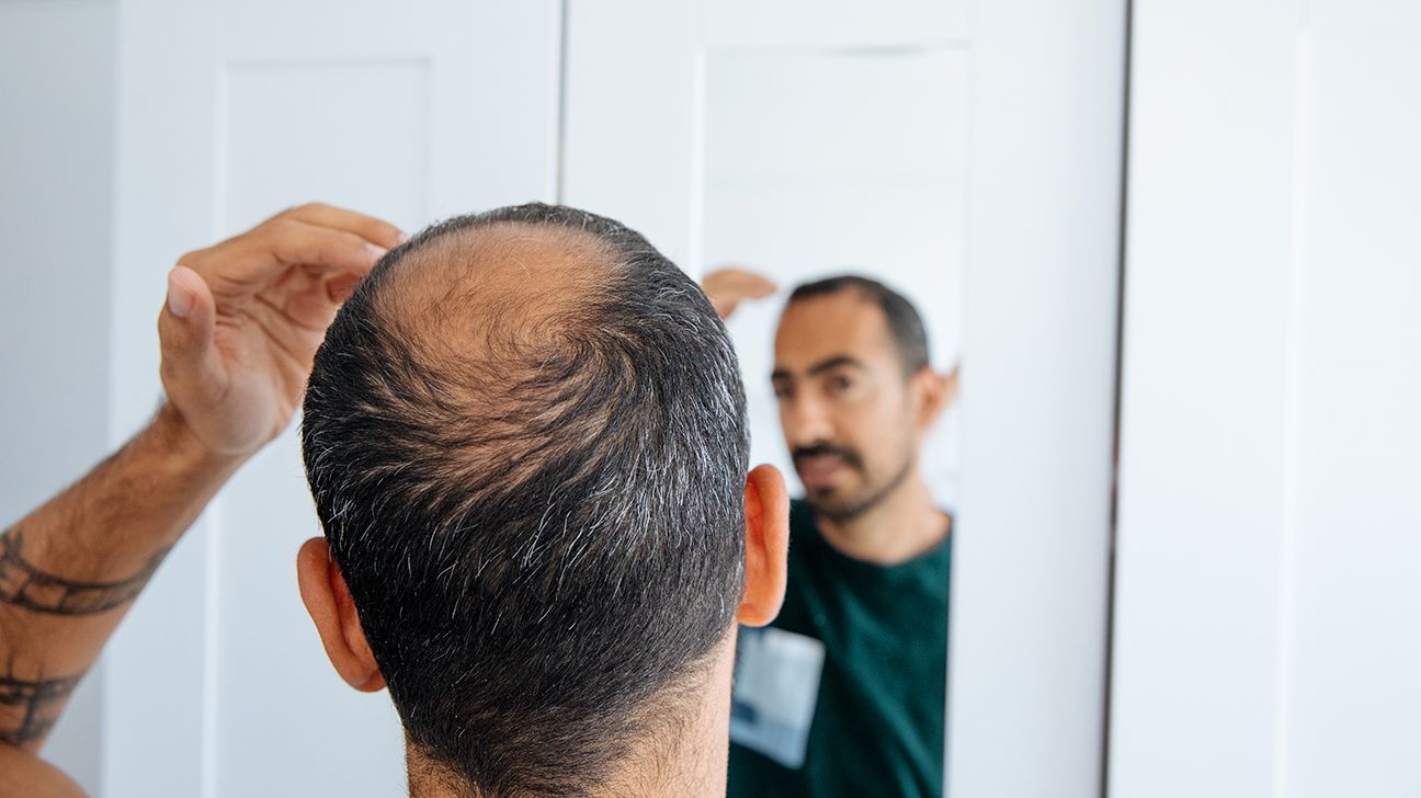 balding man