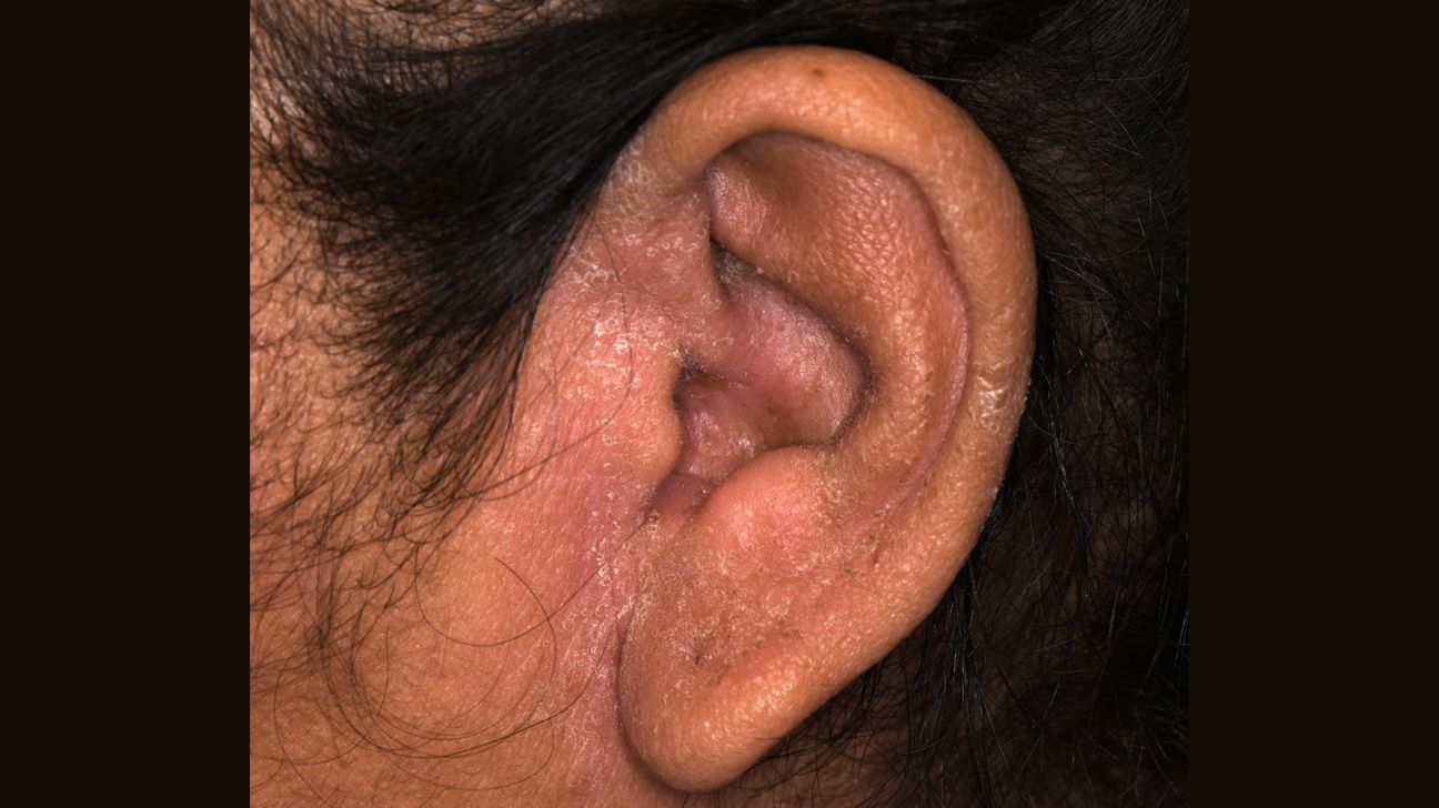 Ear Eczema: Symptoms, Causes, Treatments, and More