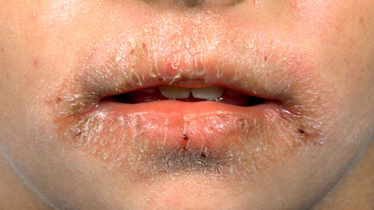eczema on lips, dermatitis, lip licker's dermatitis, saliva, lips