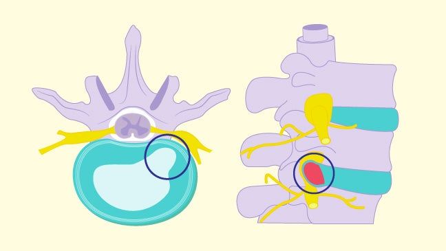 Illustration of herniated cervical discs