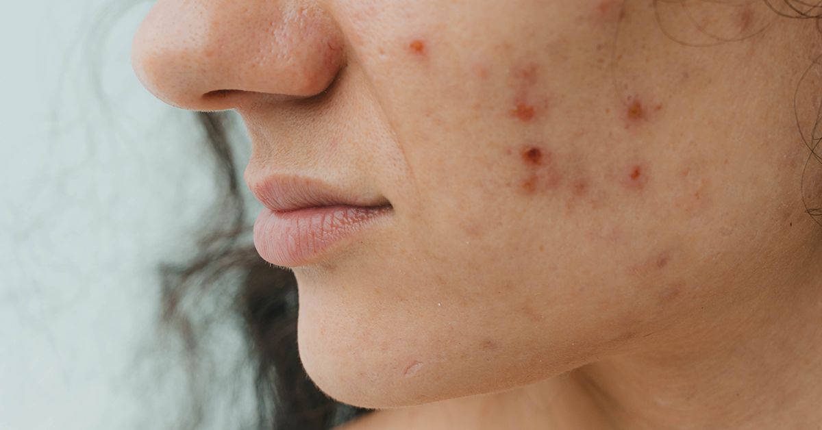 High Cortisol Levels: Symptoms, Causes, and More