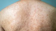Tinea Versicolor Treatment Philippines