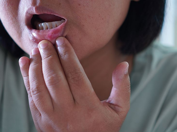 Shellfish Allergies: Symptoms and Treatments