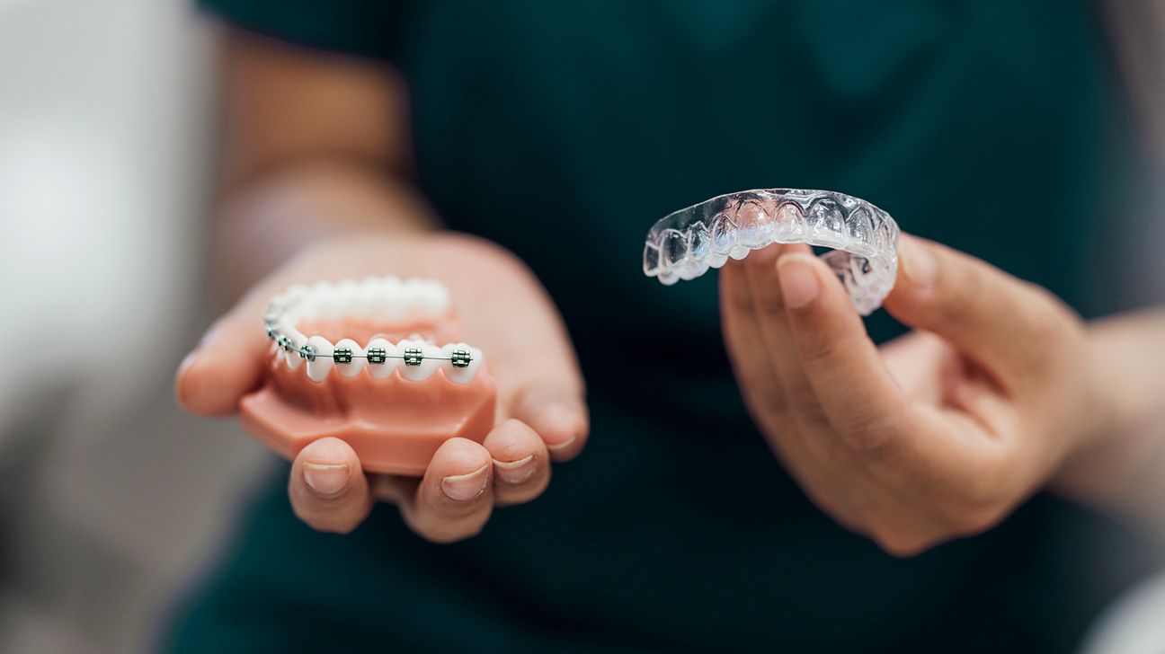 Aligners vs. braces