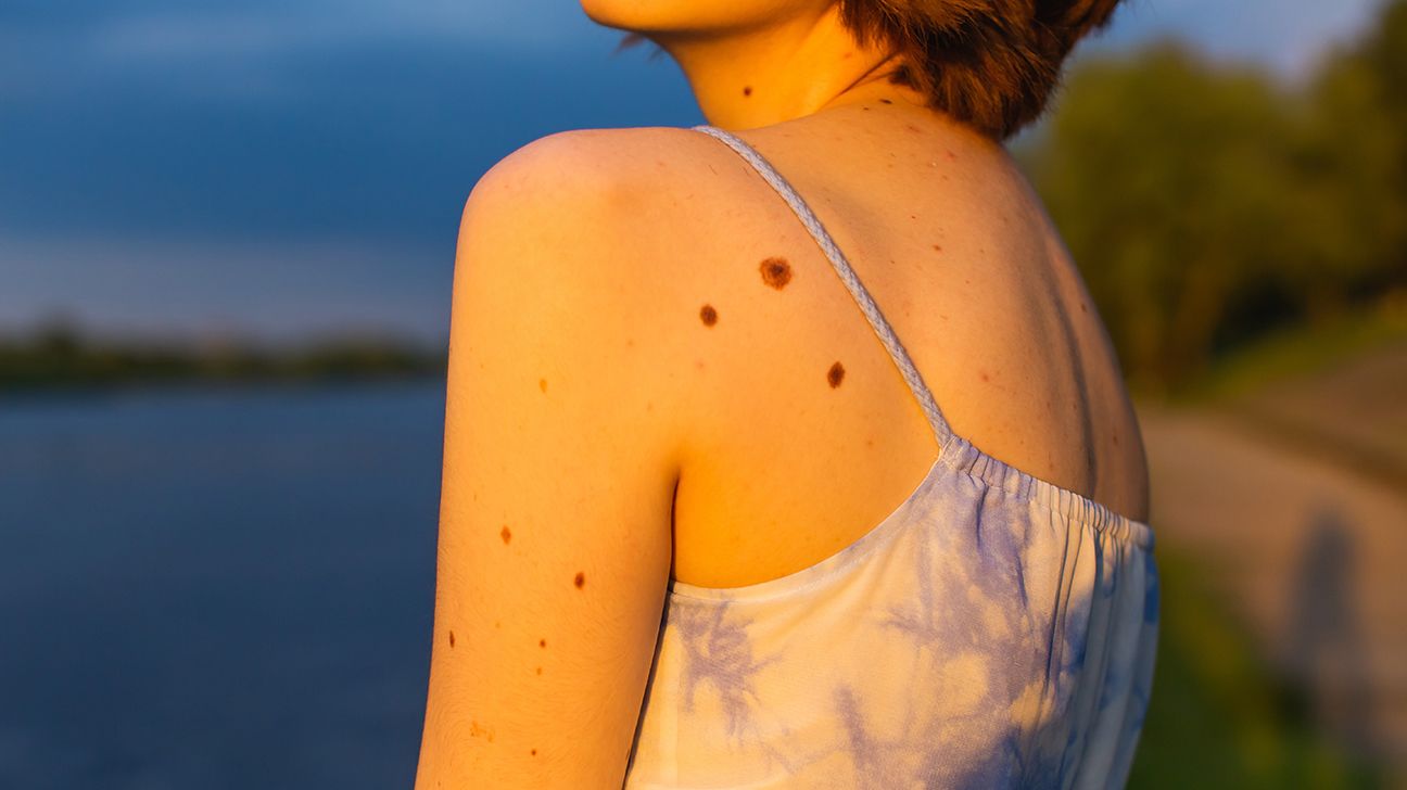 Freckles vs. moles