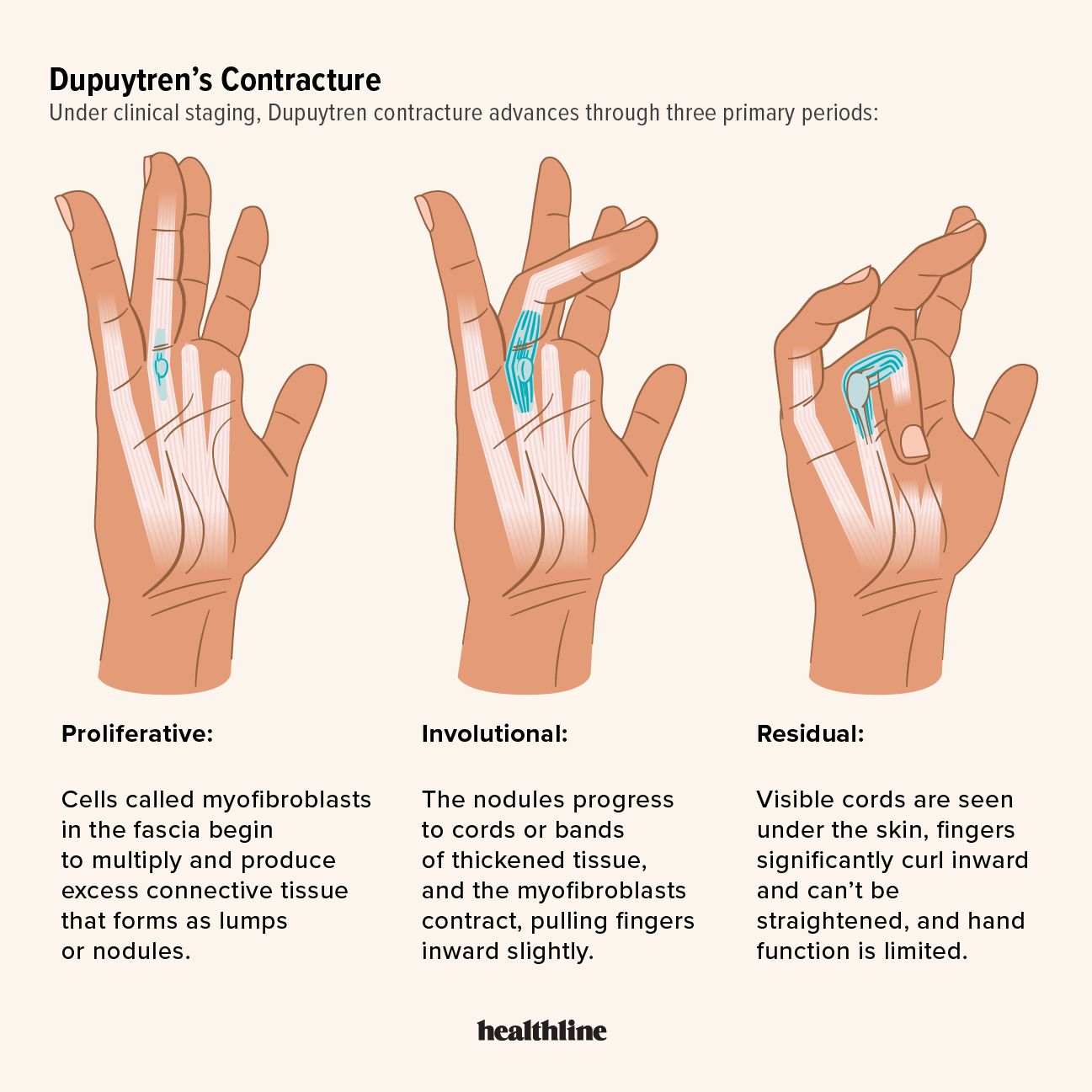 Infographic depicting Dupuytren's Contracture stages