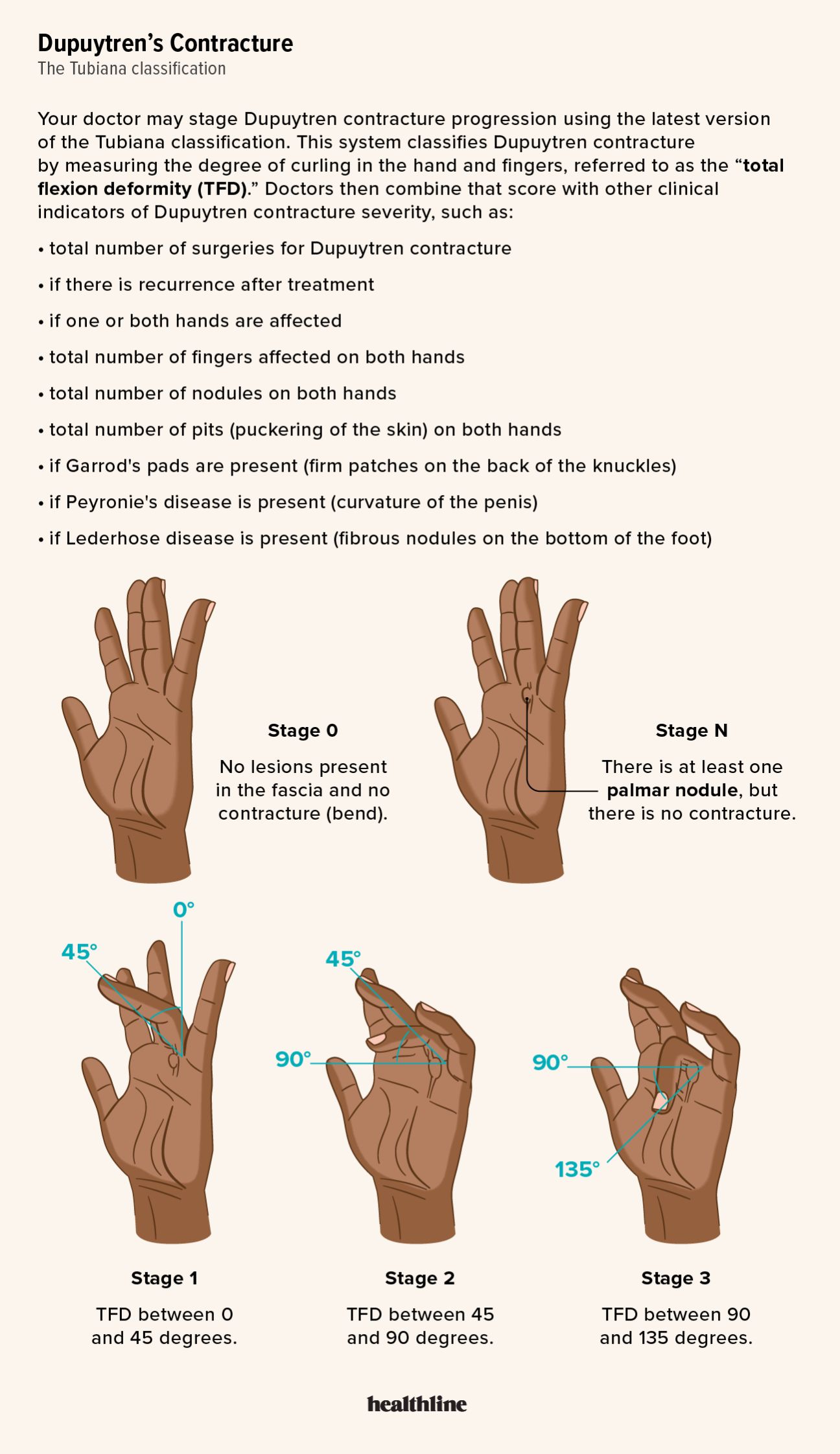 Stages of Dupuytren's Contracture