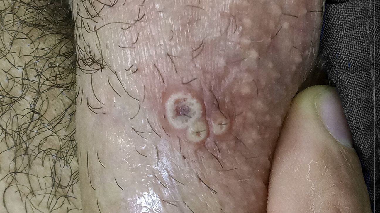 monkeypox on penis