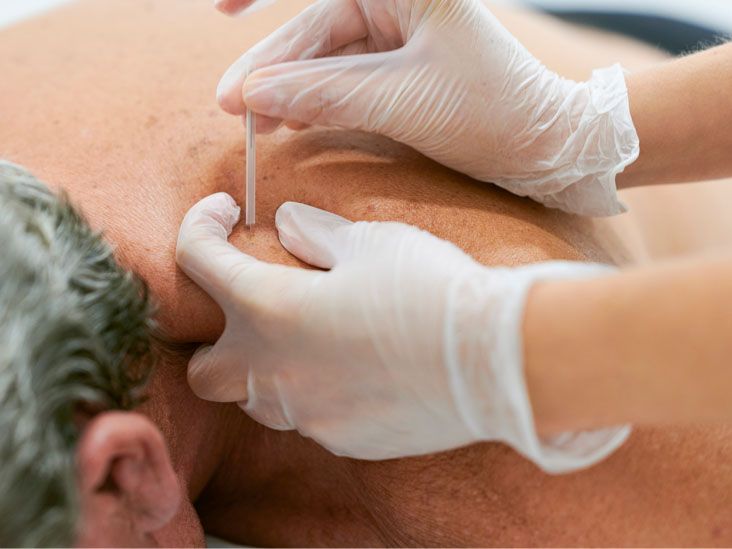 Medicare Coverage: Acupuncture for Neuropathy