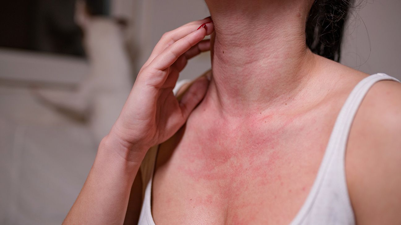 Pictures of Anaphylaxis Symptoms, image size:1296x728