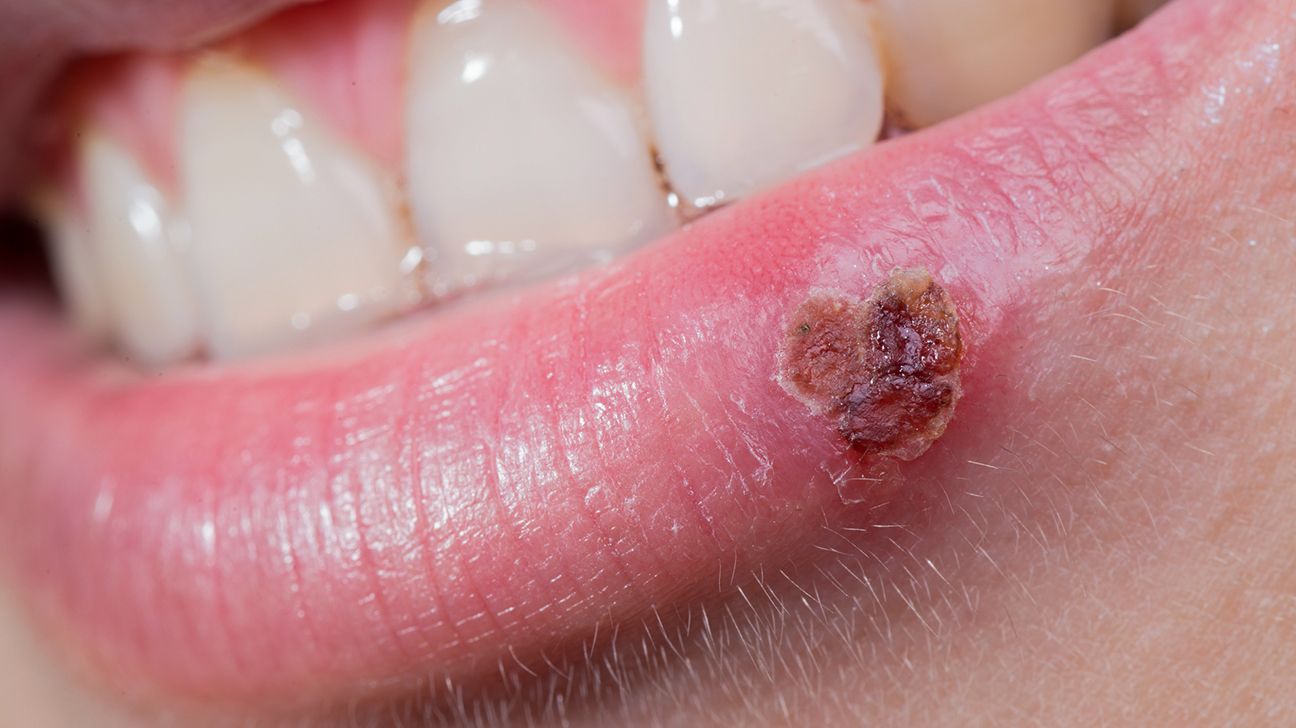 Cold Sores: Symptoms, Causes, Pictures, Treatment, and Prevention, image size:1296x728