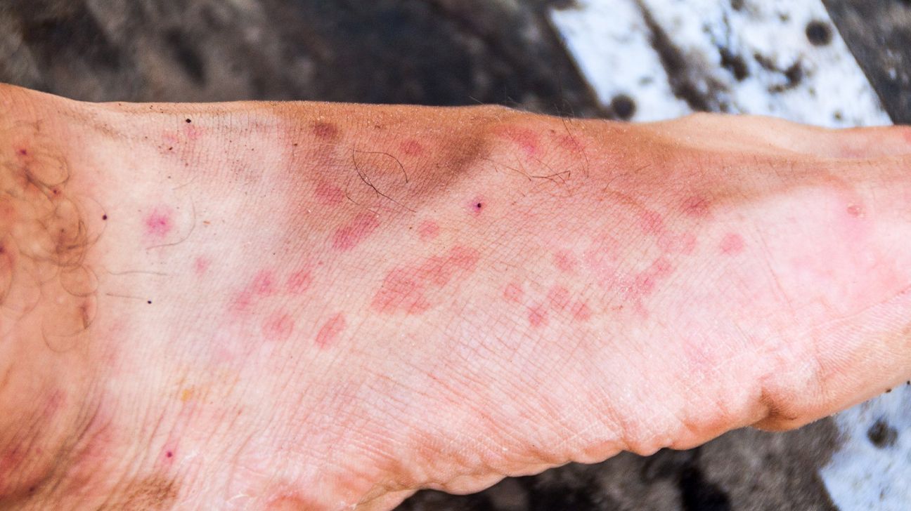 9 common types of insect bites, image size:1296x728