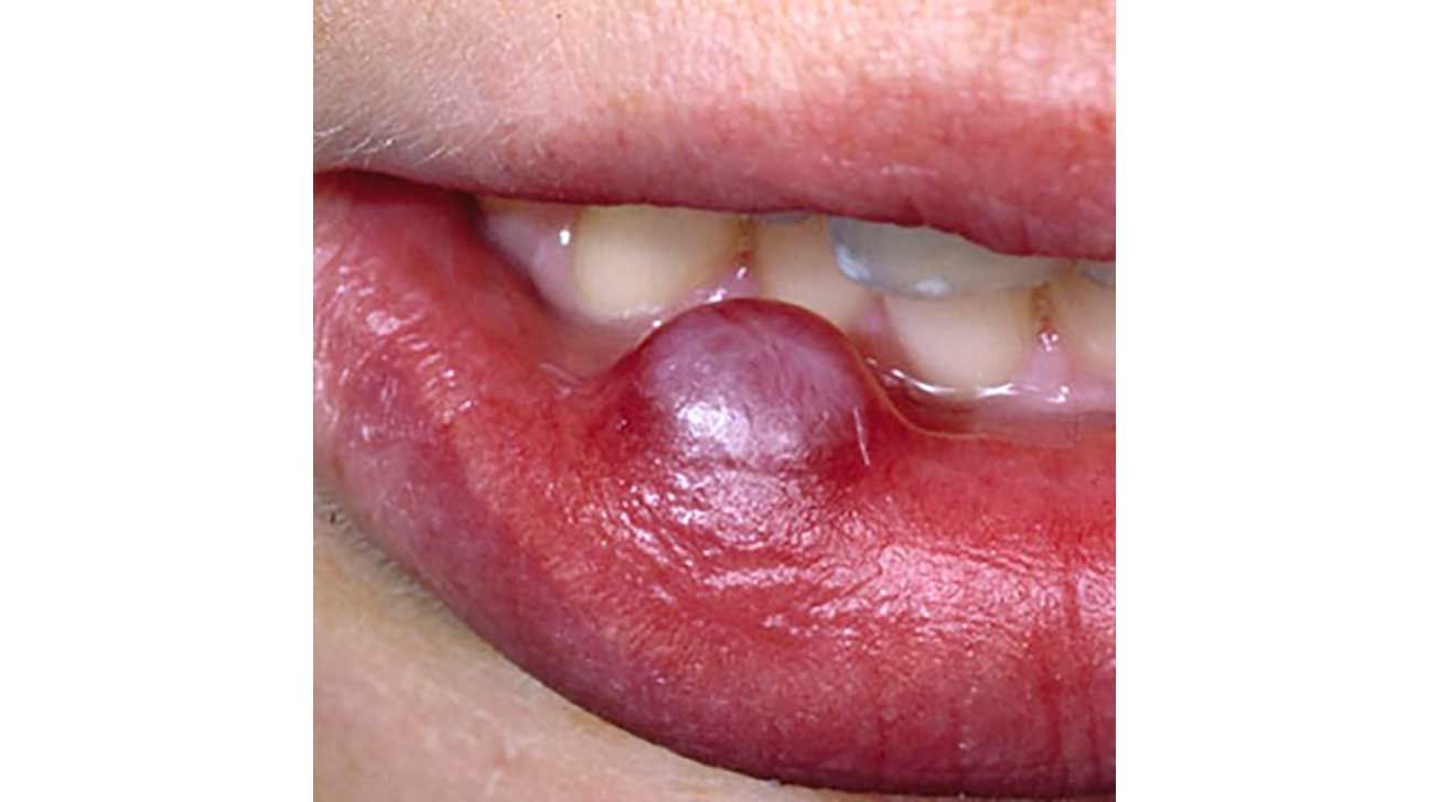 Mucous cyst on the outside of the bottom lip