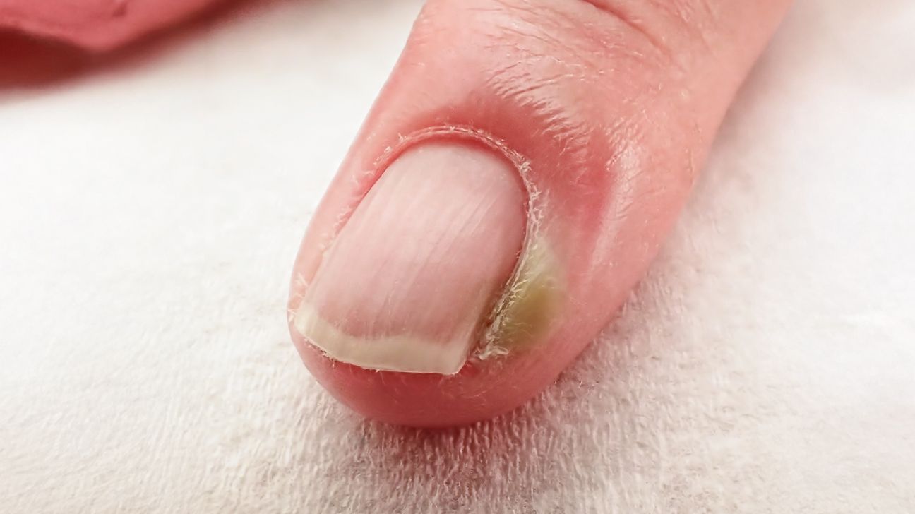 Illustration Paronychia Inflammation Skin Around Nail Stock Vector (Royalty  Free) 2016766664 | Shutterstock, image size:1296x728