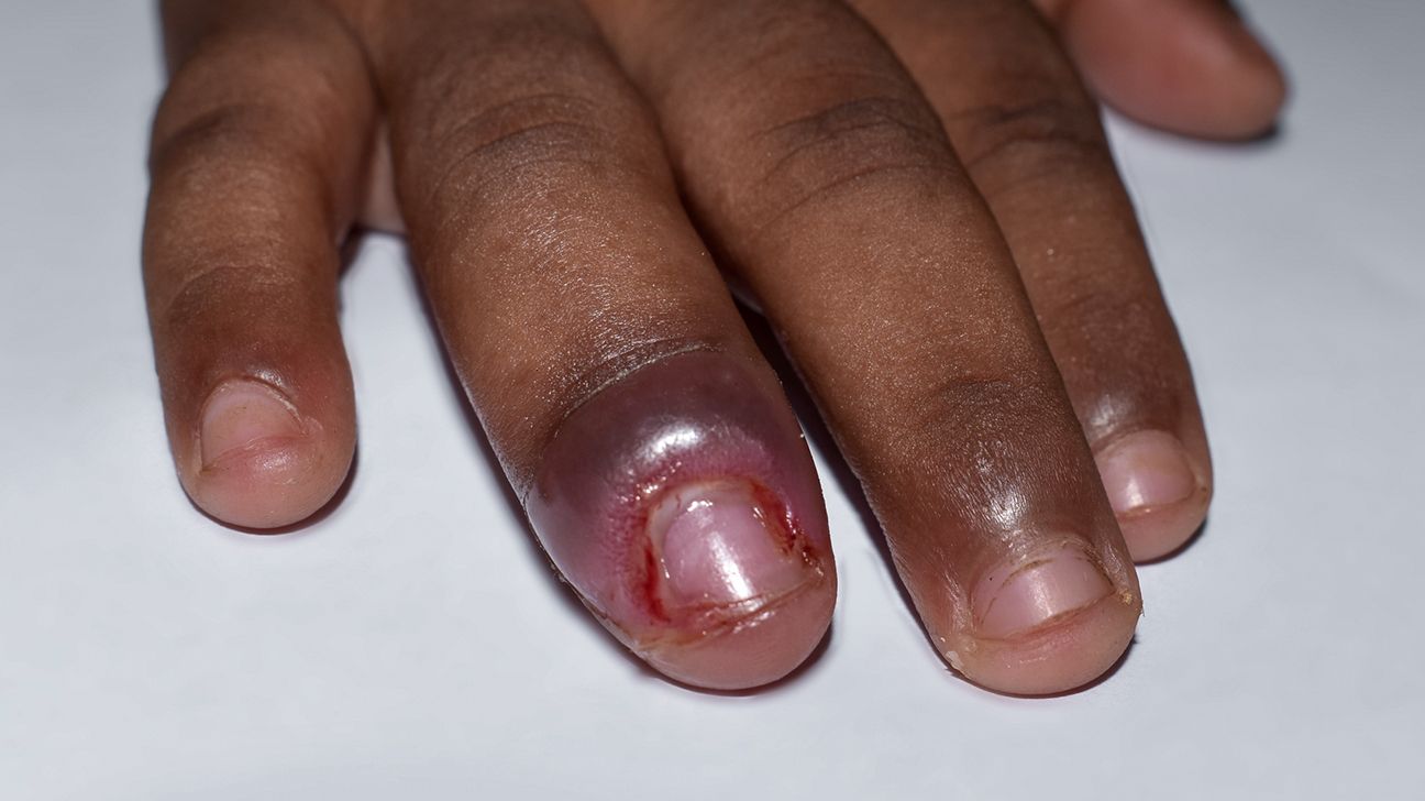 Paronychia: Causes, Symptoms, and Diagnosis, image size:1296x728