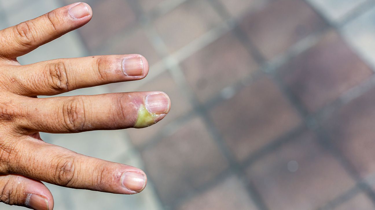 Paronychia: Causes, Symptoms, and Diagnosis, image size:1296x728