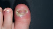 Severe Paronychia Finger Severe Paronychia Finger