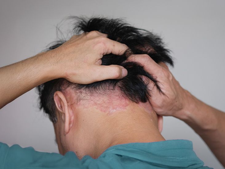 Types of Scalp Psoriasis Medications
