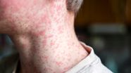 Measles Rash Morbilliform Rash Causes Symptoms And Treatment