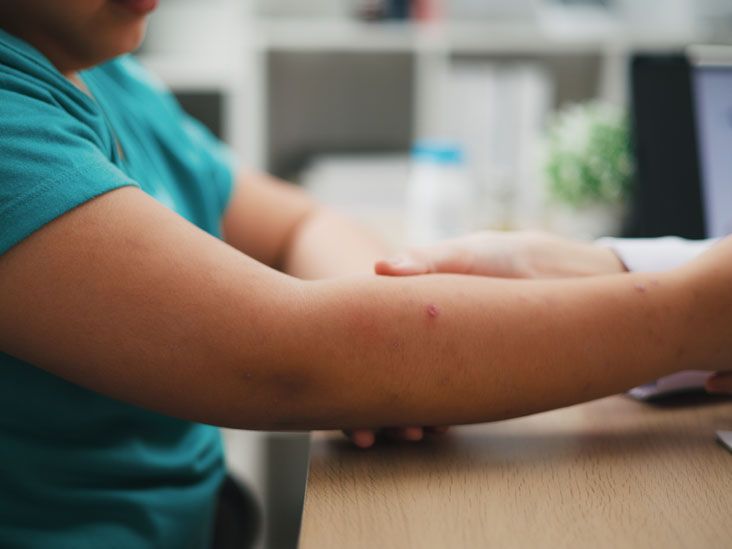 The Relationship Between ADHD and Skin Picking