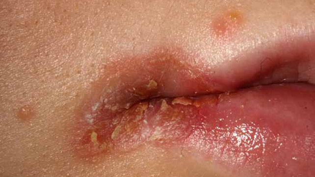 Angular cheilitis