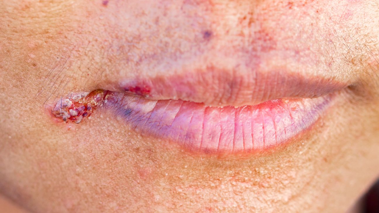 Angular cheilitis