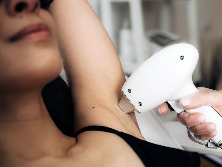 A Guide to Permanent Hair Removal Options and How Long They Last