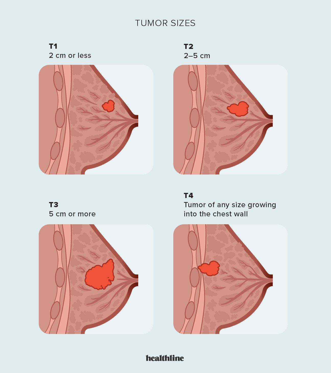breast tumor diagram