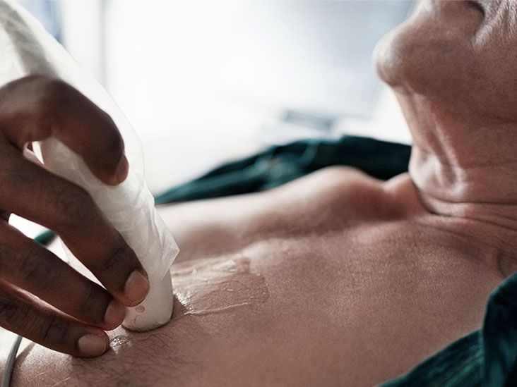 What Is Mild Cardiomegaly?