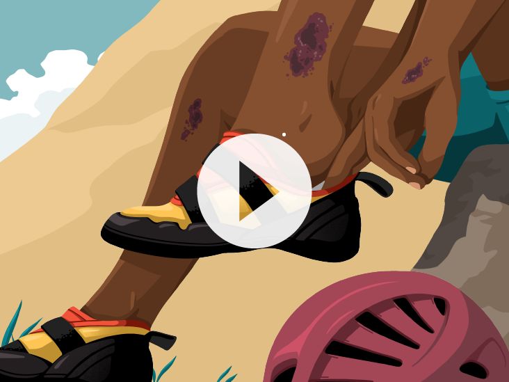 Atopic Dermatitis Facts and Stories