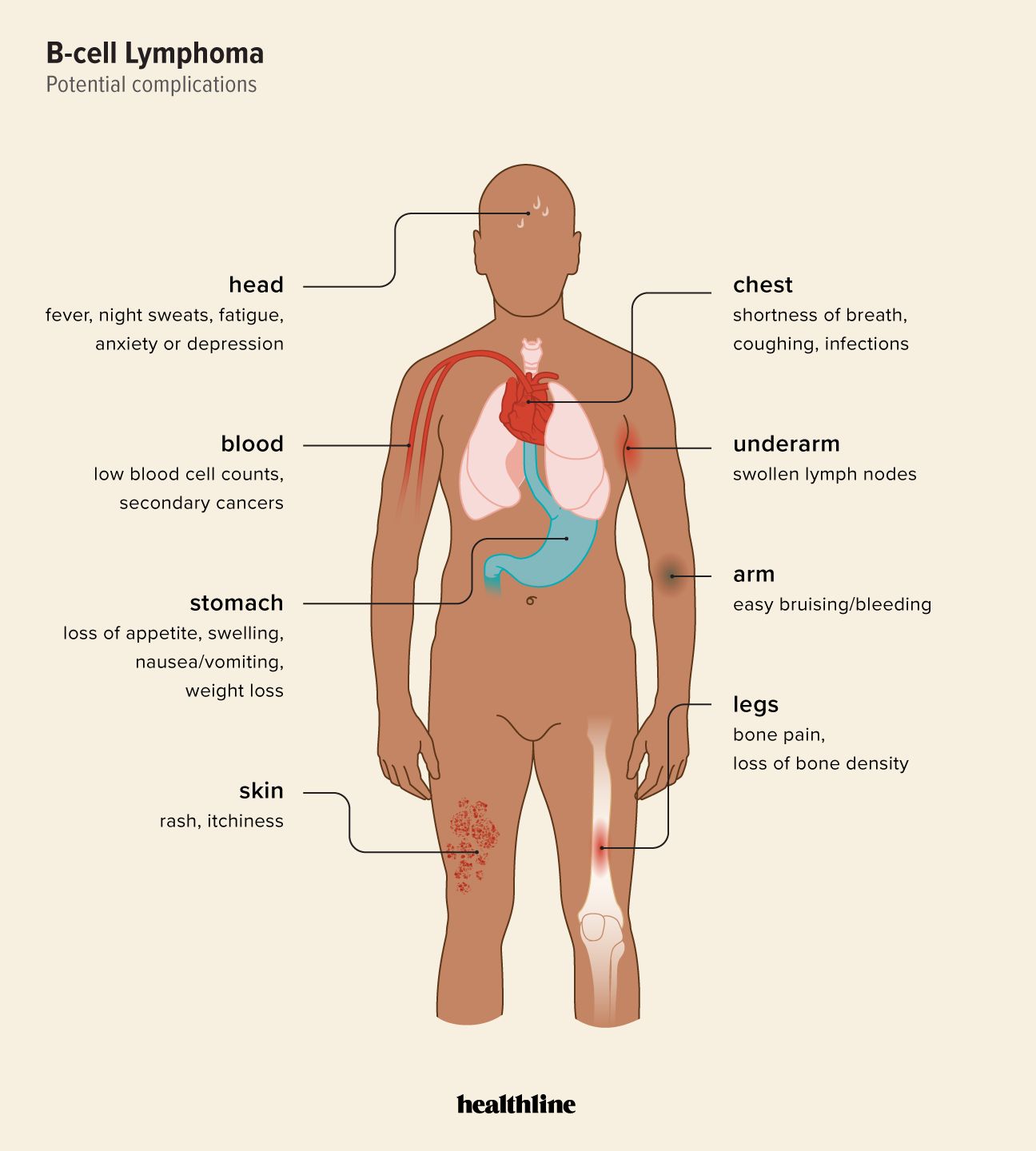 Possible complications of B-Cell Lymphoma Infographic