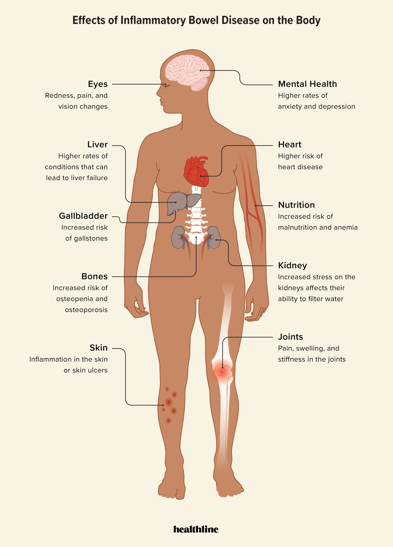 Illustration of how inflammatory bowel disease impacts the whole body
