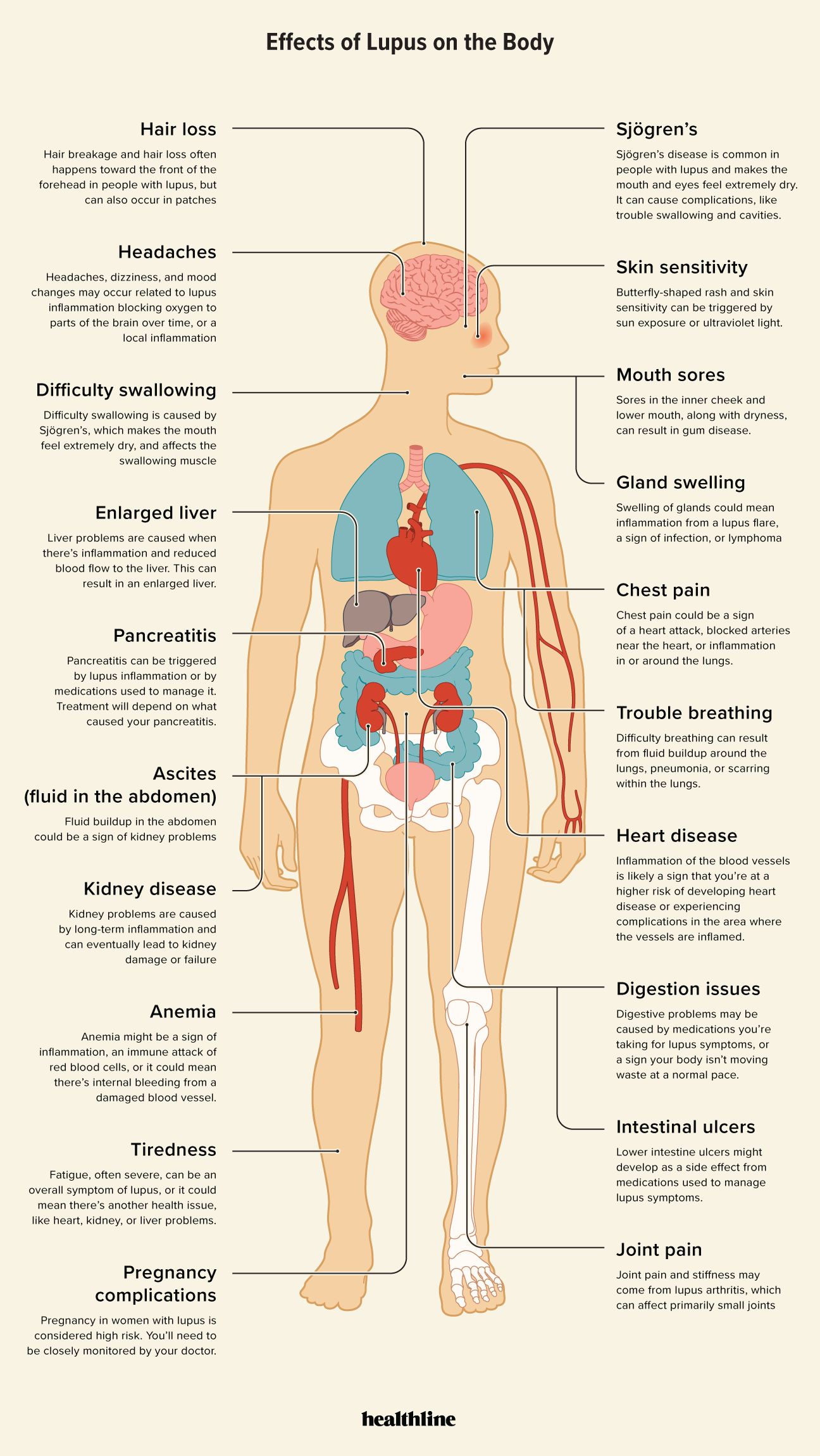 Infographic of how lupus affects the body