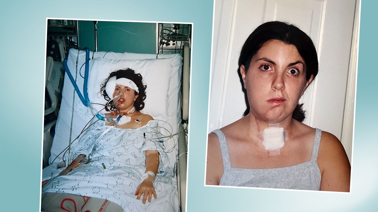 Collage of images: Jayme right after her surgery, and then during her recovery