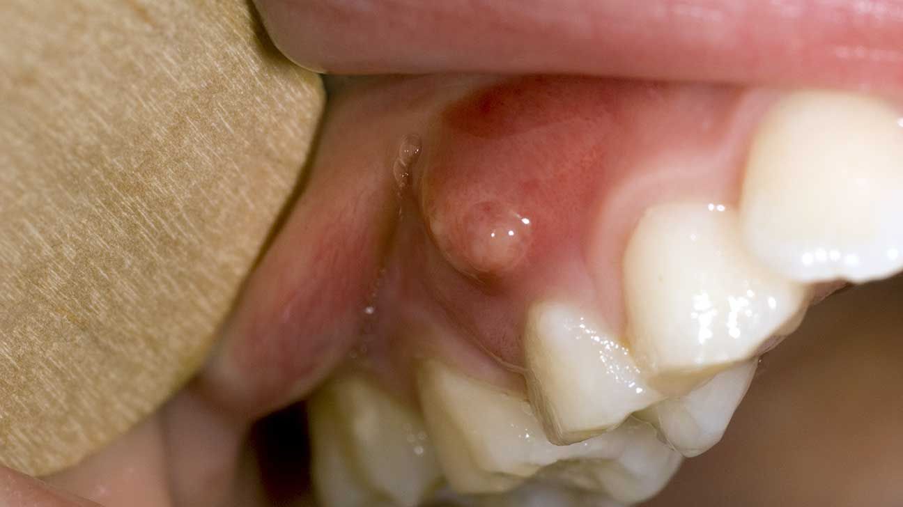 Gum boil