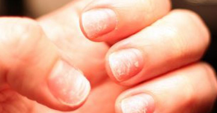 Peeling Nails? Nails Falling Off? Onychomadesis after Hand, Foot, and Mouth  in Kids