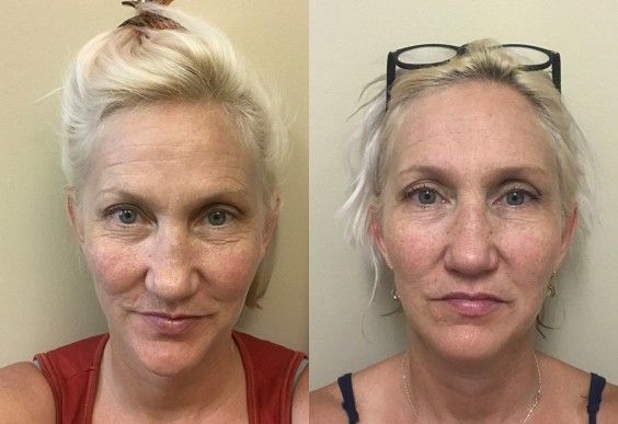 Two photos of the author, before and after face yoga