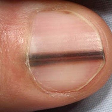 Aggregate 109+ skin cancer symptoms on nails latest