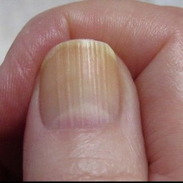 Share 143+ calcium nails white spots best