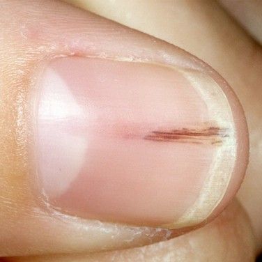 Vertical Lines On Fingernails May Indicate Certain Health Issues