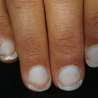 6 Things Your Nails Say About Your Health – Cleveland Clinic