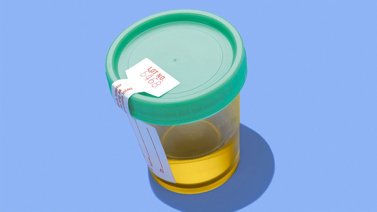 glucose test urine