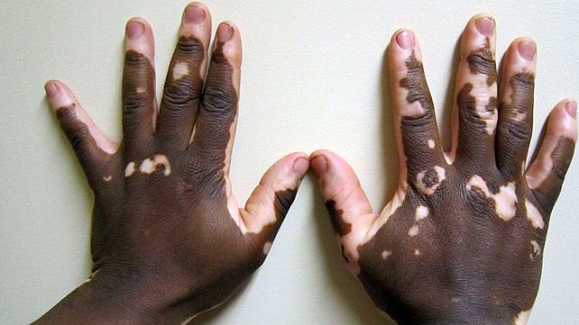 Ulcerative Colitis Rash P Rash : R/UlcerativeColitis