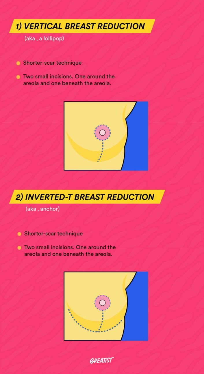 Surgical incisions for reduction mammoplasty. (a) An incision is