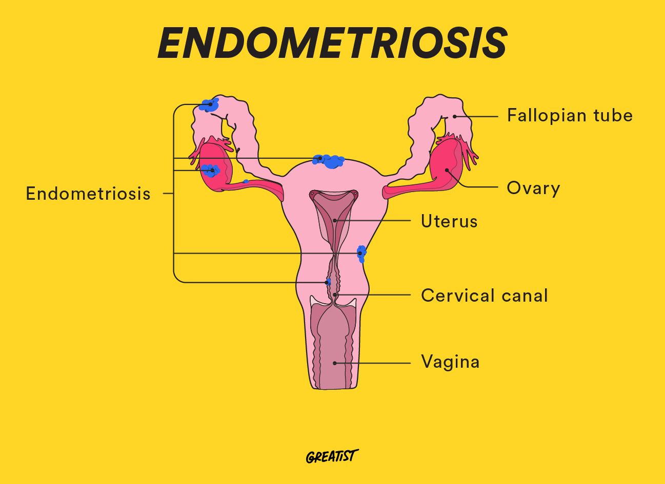 Endometriosis symptoms - breakdown of all the signs and locations