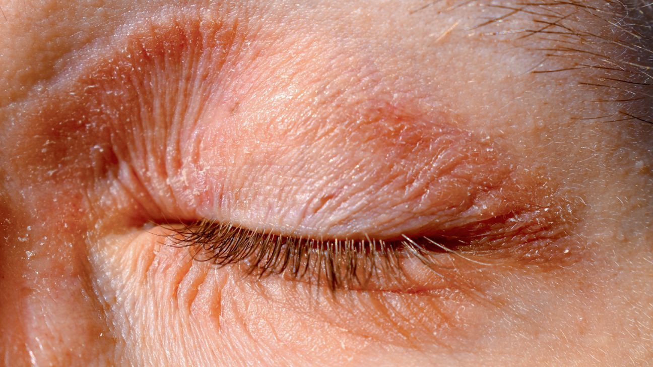 Eczema around eye