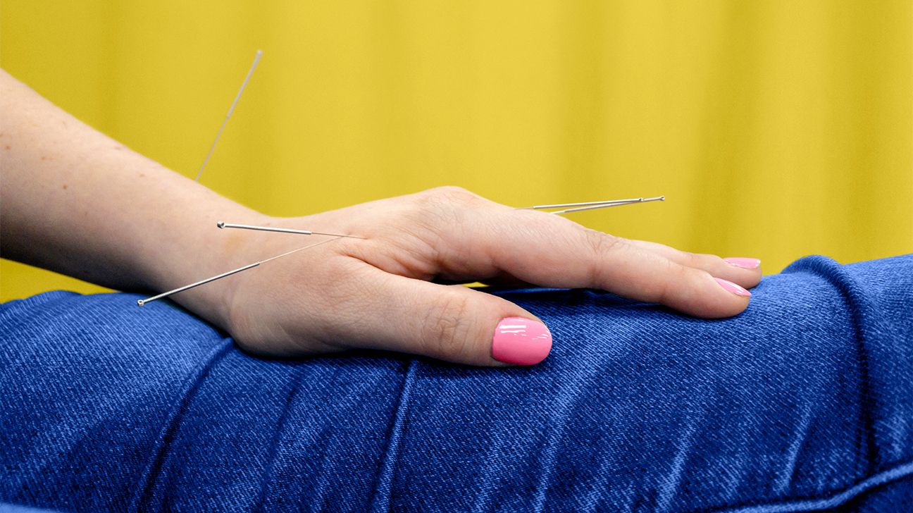 acupuncture for psoriasis