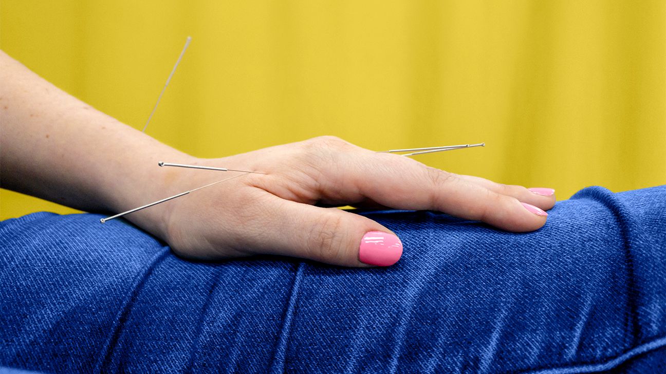 Acupuncture for Psoriasis: Does It Help?