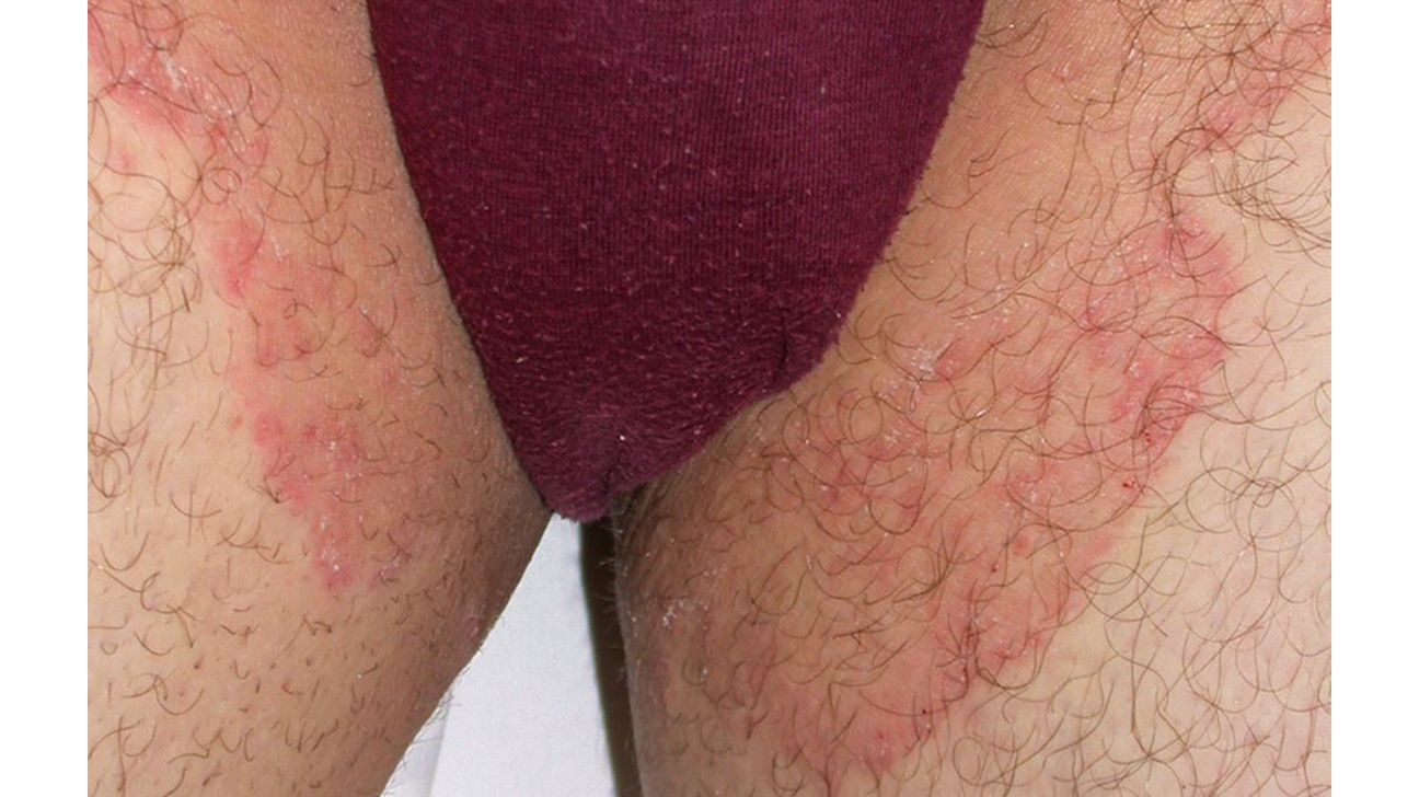 Fungal infection between thighs can be annoying and embarrassing,  especially when you are in…